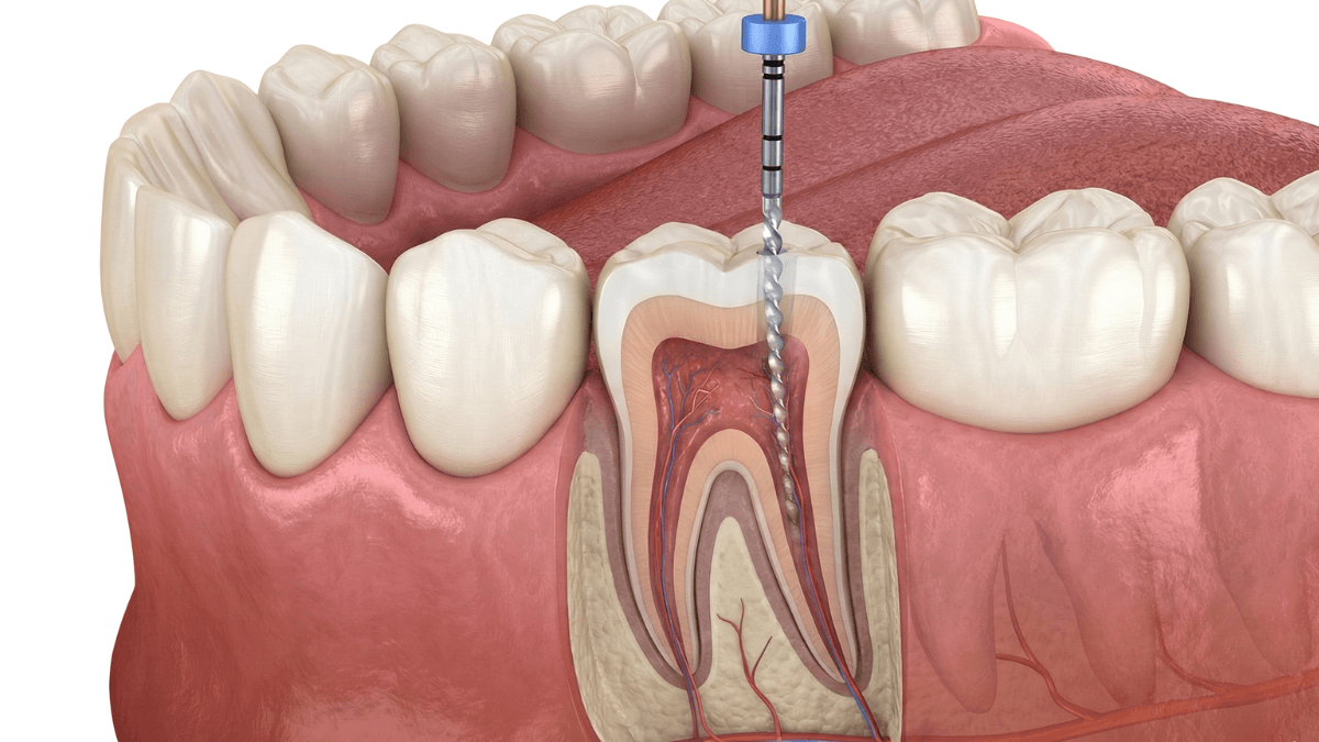 Root Canal Treatment (RCT)