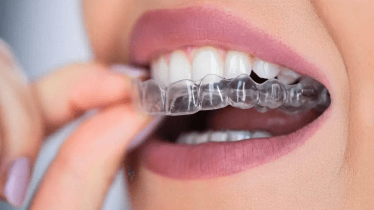 Braces & Clear Aligners