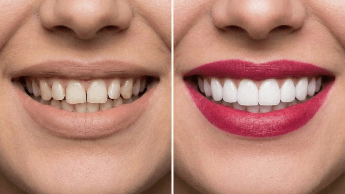 Teeth Whitening & Smile Design