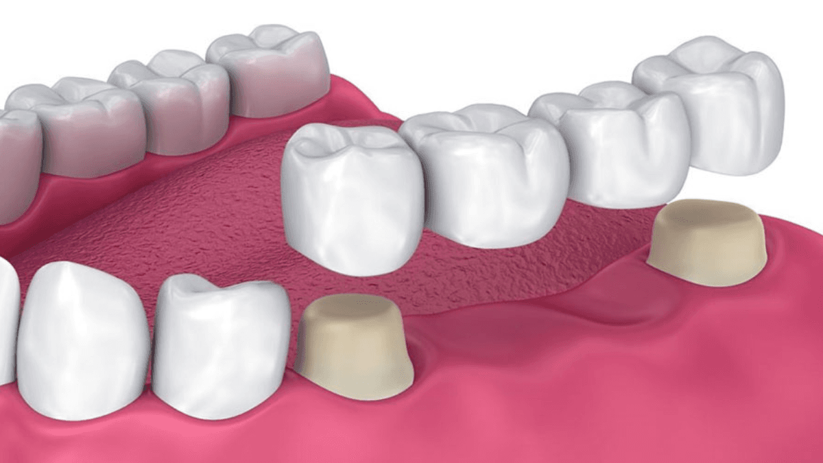 Ceramic Crowns & Bridges