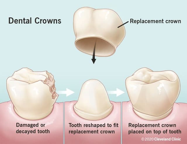 Dental Crown