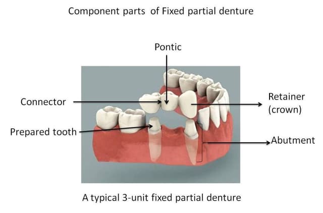 Fixed Partial Denture (FPD)