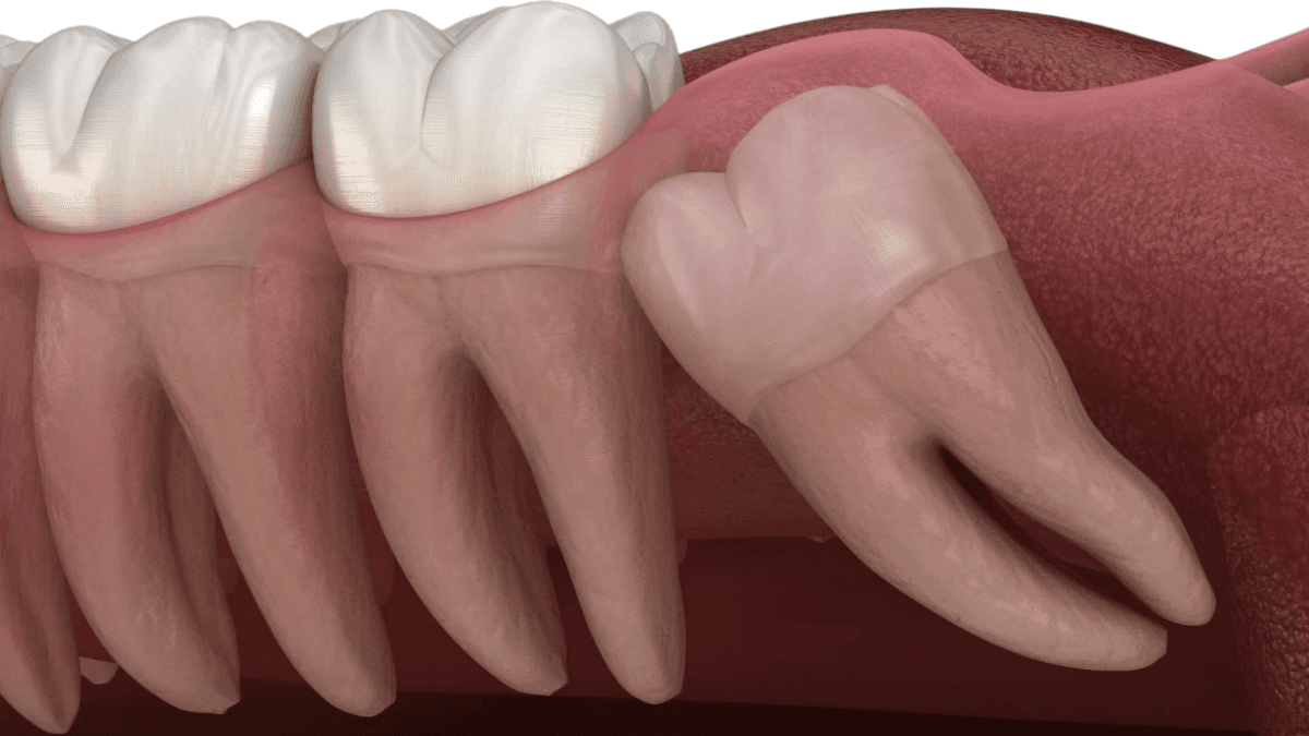 Wisdom Tooth Extraction